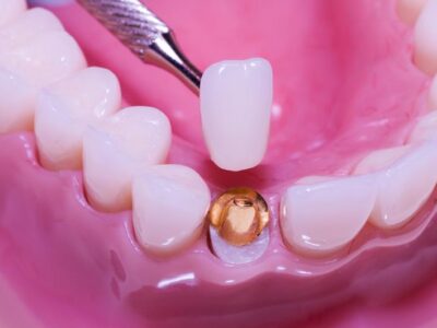 Enhancing Your Smile with Dental Crowns in Englishtown, NJ