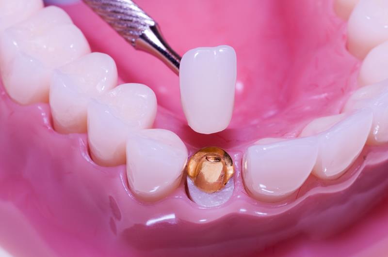 Enhancing Your Smile with Dental Crowns in Englishtown, NJ