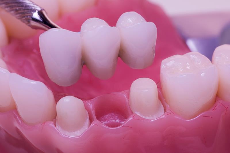 Dental bridge