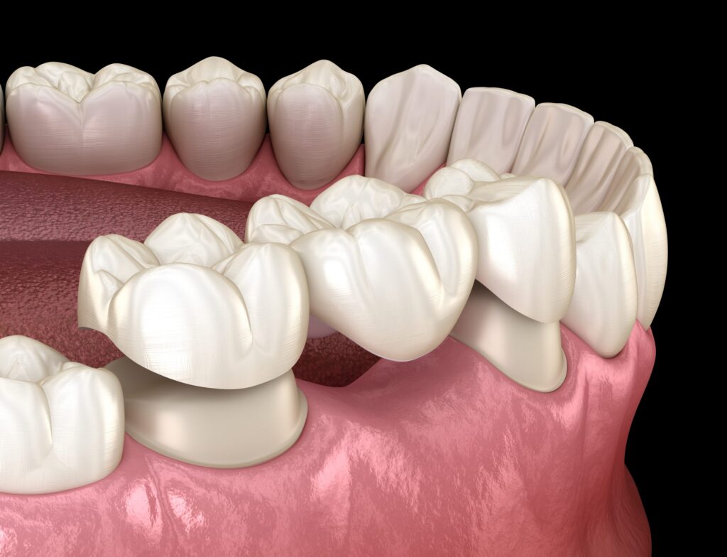 Everything to Know About Dental Bridges