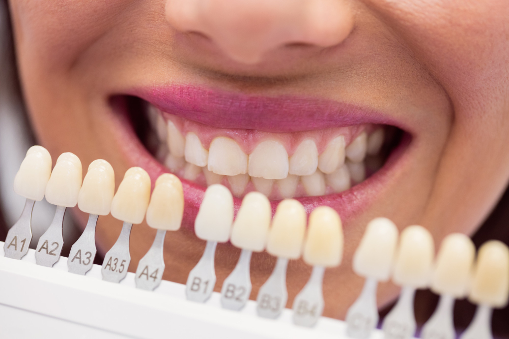 Porcelain veneers