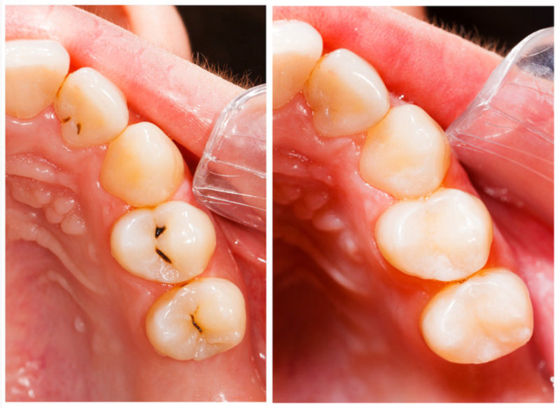 Tooth-colored dental filling