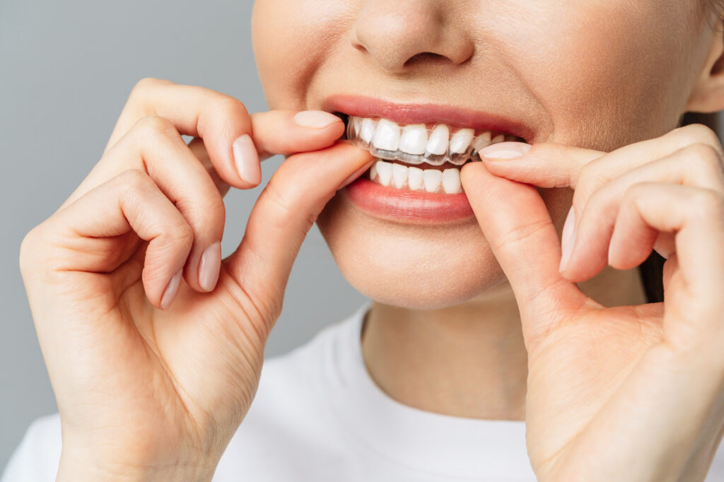 Tips For New Invisalign Aligners