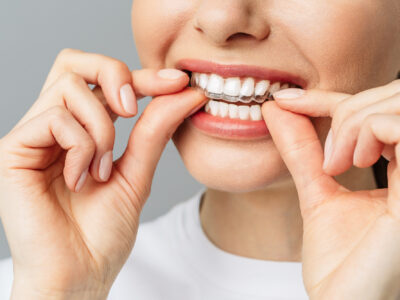 Tips For New Invisalign Aligners