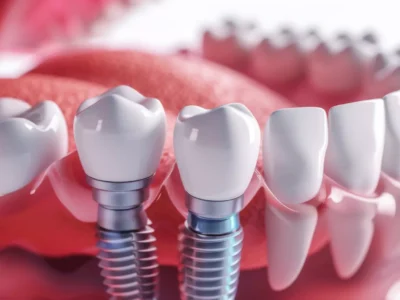 Why Dental Implants Are A Game-Changer In Restorative Dentistry?