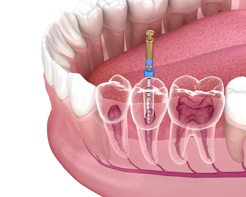 Everything You Need to Know About Root Canal Treatment in Englishtown, NJ