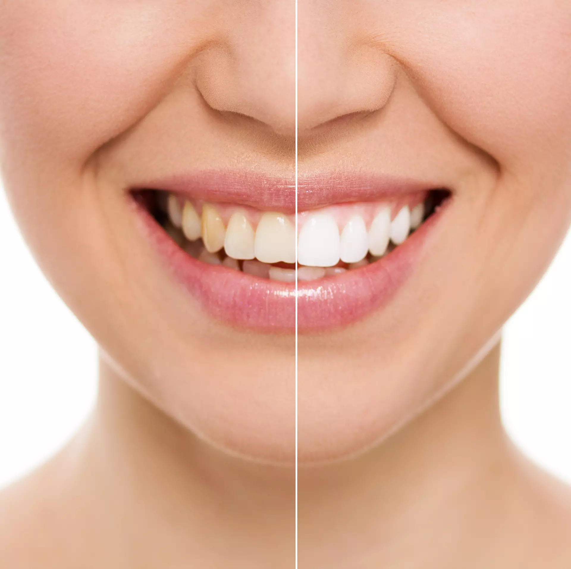 Bright smile after Zoom teeth whitening