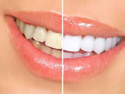 Brighten Your Smile with Zoom Teeth Whitening in Englishtown, NJ